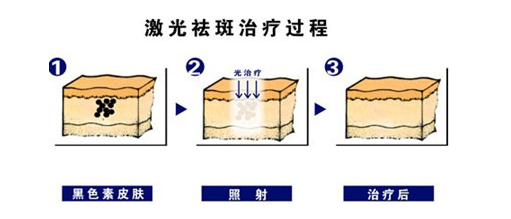 激光祛斑