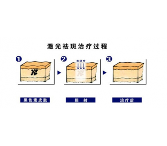 激光祛黄褐斑——祛斑新方法