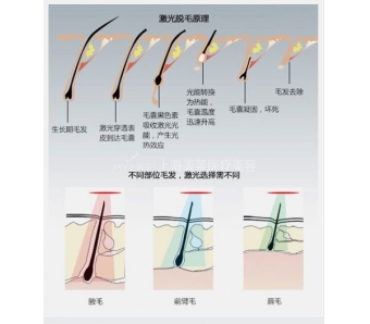 上海适合女性的脱毛方法