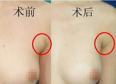 副乳能不能切除呢