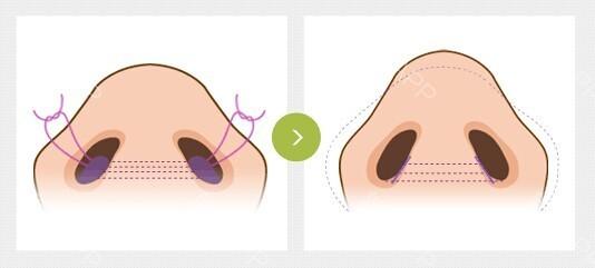 鼻翼缩小手术多少钱
