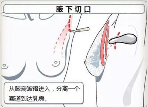 化学酸换肤祛痘