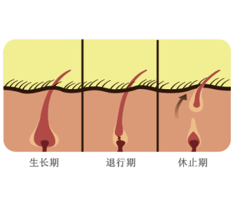 做激光手臂脱毛后毛发会越来越粗吗