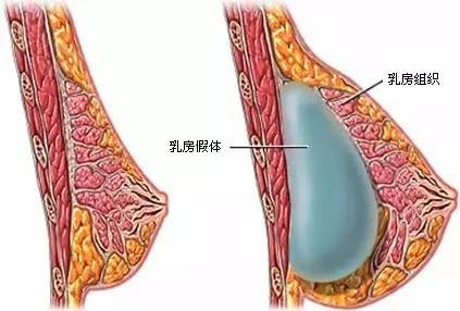 上海面部自体脂肪填充的效果到底是怎么样的