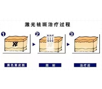 美莱微整形：都是玻尿酸，水光针和填充用的什么差别