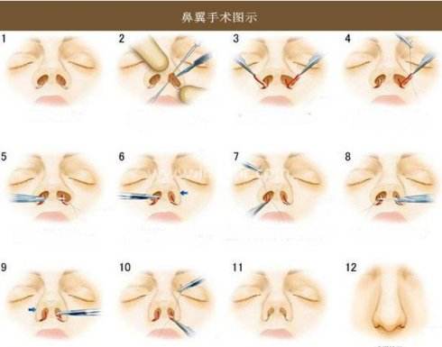 上海全切双眼皮一般缝几针