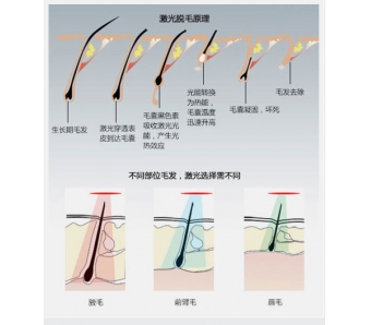 上海激光脱毛怎么快速去除腋毛